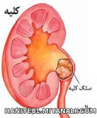 نسخه گیاهی برای دفع سنگ کلیه